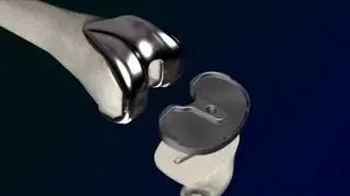 Premier Orthopaedics Total Knee Replacement