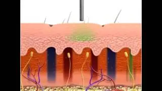 Tattoo Removal Brisbane with the Medlite C6 Laser