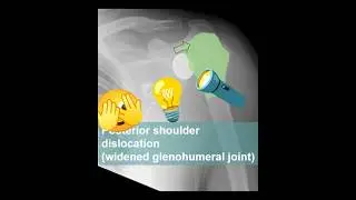 Posterior shoulder dislocation