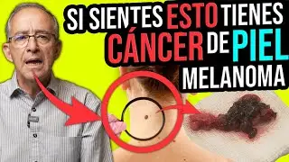 CUIDADO SI SIENTES ESTO TIENES CANCER DE PIEL O MELANOMA - Oswaldo Restrepo RSC