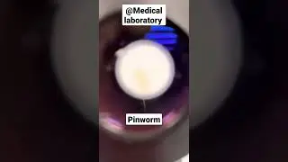 Pinworm parasite 🪱🪱.||#shorts.