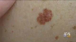Skin Cancer Awareness Month Kicks Off Today