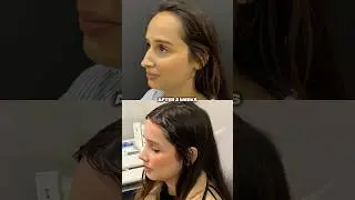 Combined Rhinoplasty 👃🏼 + Forehead Reduction 💆🏻&zwj;♀️  Dr. Ahmet Dilber 🪄