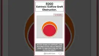 EOGO: EXTRINSIC OUTFLOW GRAFT OBSTRUCTION.