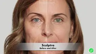 Procedure Before and After - Revive Med Spa