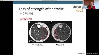 Loss of Strength After Stroke: StrokeEd Lecture