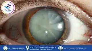 Expert Insights on Contoura Vision LASIK &ndash; Part 6 | Standard LASIK vs. Contoura Vision LASIK