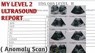 My Anomaly scan report/Level 2 ultrasound
