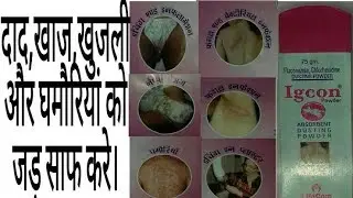 Igcon dusting powder review in hindi./दाद,खाज,खजुली,और घमौरियों को जड़ से साफ करें।