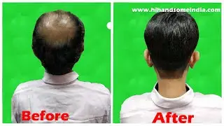 Hair Wig Tapping System | Hair Wig | Hair Patch | Non Surgical Hair Transplant in Bihar