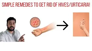 3 Herbal remedies for Urticaria/ Hives!