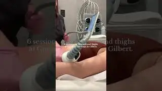 My Experience Getting Venus Legacy Cellulite Treatment! #shorts #shorts2025