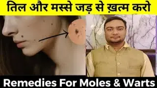 मस्से को जड़ से हटाने के उपाय | 100% Effective | Best Mole Removal treatment | warts Video In Hindi