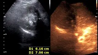 Hepatic Mass |  Large hepatic adenoma | Absence Left Kidney