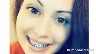 Braces (Fast-Braces) 2 month update/Q&A