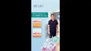 Liposuction & Lipedema Surgery | Innovative Technique for Smoother Skin | Artlipo |Expert Dr. Su