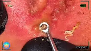 Relax Every Day | Deep Skin Care Extractions &ndash; OddlySatisfyingExtractions #6