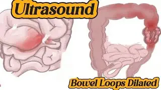 How to diagnose Dilated Bowel Loops | Ascites | Uterus | Enteritis Colitis | Abdomen ultrasound