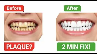 2 Minute Trick to Remove Plaque & Whiten Teeth Naturally!
