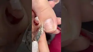 Lots of cuticles and dry skin #pedicure #nails #nailcare #satisfying #toenails