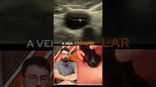 Diferenciando a art&eacute;ria car&oacute;tida comum da veia jugular interna