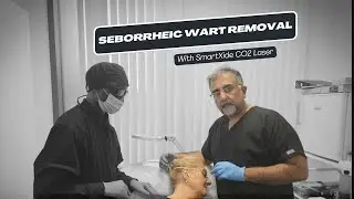 Transforming Wart Removal with SmartXide CO2 Laser