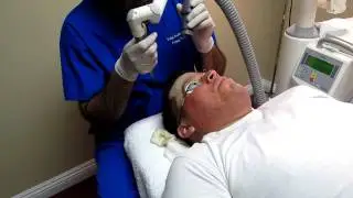 Acne Scar Removal-Deep Erbium Laser Peel-Anaheim-Fullerton-Orange-Brea-Irvine-Huntington Beach