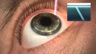 Alcon WaveLight Refractive Suite
