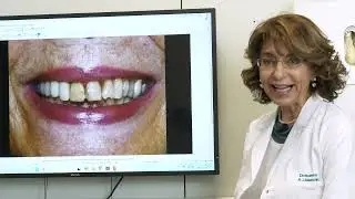 Denti di colori diversi. Come intervenire?