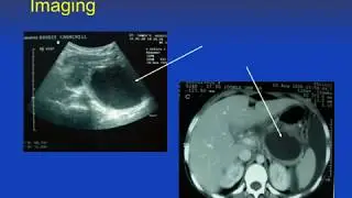 Endoscopic Drainage of Pancreatic pseudocyst.mov