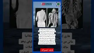 هاري إيستلاك: قصة ملهمة (Harry Eastlake: An Inspiring Story)#التعظم_التدريجي_الليفي #الحرب