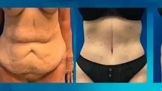 Body Contouring options for trunk with Dr. Fallucco