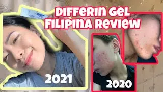 HOW I CLEARED MY SKIN | Differin Gel FILIPINA HONEST REVIEW 🇵🇭🇵🇭🇵🇭