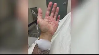 Georgia ranks 5th among states with highest monkeypox cases