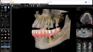 CS 3D Imaging Premium: Acelera tu flujo de trabajo para la planificaci&oacute;n de implantes con IA