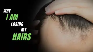 How to Stop Hair Loss At Early Age?