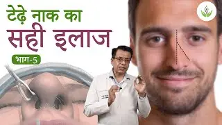 टेढ़ी नाक का सफल इलाज (भाग - 5) । केयर वेल मेडिकल सेंटर
