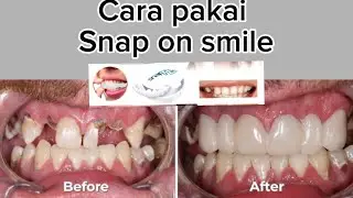Snap on smile fake teeth oral care natural bleaching dental