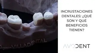 ¿Qué son las incrustaciones dentales y qué beneficios tienen? | Clínica dental Avodent
