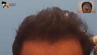 4650 Grafts Strip + Bio FUE Hair Transplant by Dr Kapil Dua, India