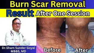Results of Burn Scar Removal | After One session | Kayakalp Laser Clinic