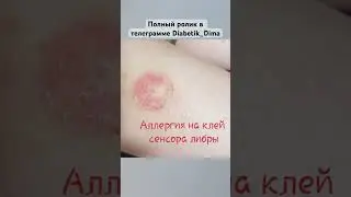 Аллергия на сенсор глюкозы крови #диабет #мониторингсахара #diabetikdima