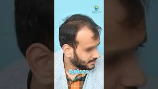 Dermalife Hair Transplant Results Before and After #shortsfeed #shorts #hairtransplant