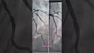 Pre and post MINI CRUSH #angioplasty #cardiology #education #cardiaccatheterization