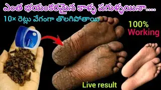 ఇది రాస్తే ఎంత మొండి కాళ్ళ పగుళ్ళయిన 3 రోజుల్లో తొలిగిపోతాయి #Remove crack heels #Soft feets 