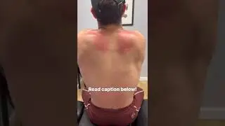 Muscle Scraping By a NYC Chiropractor #getadjusted #chiropractor #neckcrack