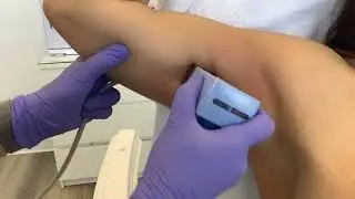 Morpheus8 Treatment on arms