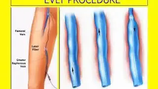 Cosmetic Surgery San Ramon | Vein Treatment Animation
