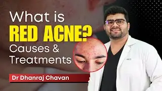 🤔 | What Is Red Acne Marks? | Acne Causes And Best Treatments Pune | Home remedies for Acne