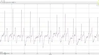Importing ECG _data using matlab and SPtool